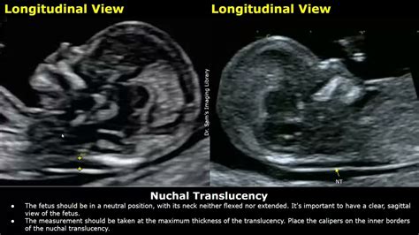 how to measure nuchal fold thickness|nuchal translucency normal range at 13 weeks.